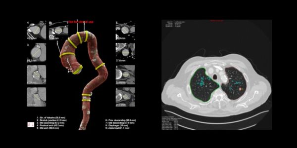 AI,会让放射科医生下岗吗?