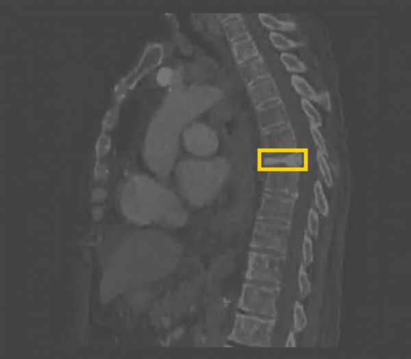 AI,会让放射科医生下岗吗?