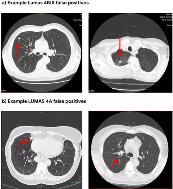 谷歌：AI预测肺癌，准确率高于医生