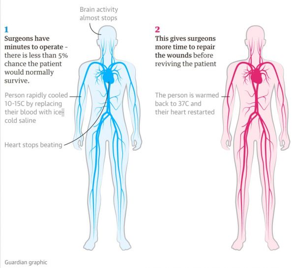 起死回生:美国科学家首次让人类进入“假死状态”,换取手术时间