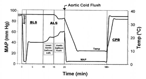 起死回生:美国科学家首次让人类进入“假死状态”,换取手术时间