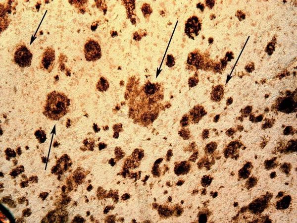 以“阿尔兹海默症”为案例,AI+慢病管理该怎么做?