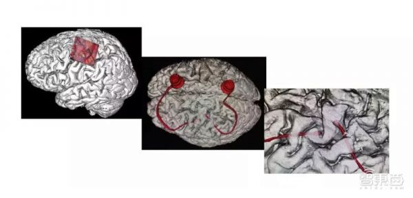 中国首例,大脑植入电极,高位截瘫病人用意念喝水