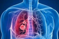 同济专家：为什么新型冠状病毒感染重症多为老年人