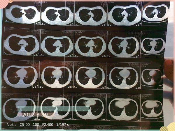 检测新冠病毒,AI功能终于找到真正价值?
