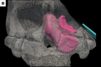 医生像玩AR游戏一样，切下了我鼻窦里的肿瘤