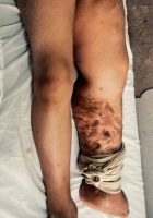 大腿肿成三倍的“食物中毒”：抗生素耐药有多严重？