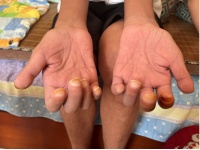 尘肺病侵入90后