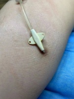 短肠人之困，当一个人的小肠只剩30厘米