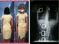 22岁成了残疾人：被脊柱“扭曲”的青春