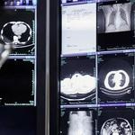 攻克胰腺癌早筛难题，阿里AI模型获国际权威认定“突破性医疗器械”