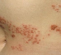 一个方子“止痛如神”，一切带状疱疹后遗痛轻松搞定