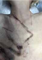 女子泡澡时充电玩iPad触电身亡，胸口现设备轮廓电击痕