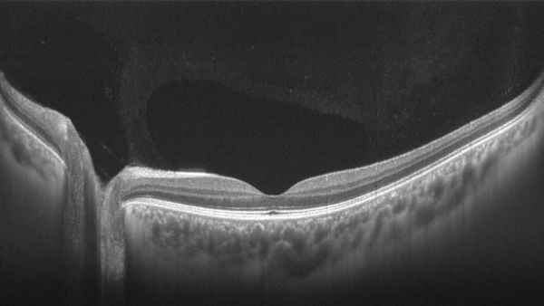 融资合伙人入围项目 | 眼科扫频OCT产品进口替代进行时，「图湃影像」认为一二级医院是主要战场