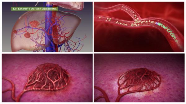 落地实体医疗项目「赛祺尔医疗」,中杉肿瘤医生集团要将晚期癌症新疗法引进大陆