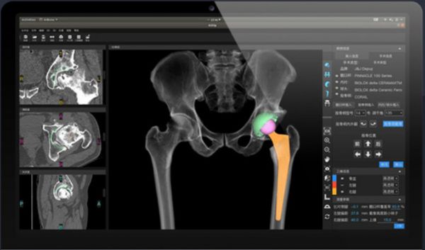36氪首发 | 提供AI骨科手术全流程解决方案，「长木谷医疗」获数千万元Pre-A轮融资