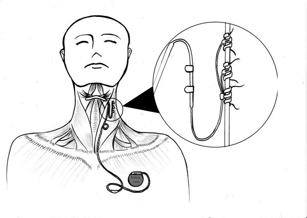 36氪首发 | 自主研发有源植入神经刺激器,「瑞神安」获数千万元A轮融资