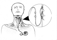36氪首发 | 自主研发有源植入神经刺激器，「瑞神安」获数千万元A轮融资