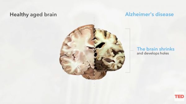观察+ | 阿尔茨海默症等来了“灵丹妙药”？谨慎看待不“捧杀”