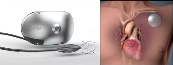 靶向药之后又有了新方法，Aria CV用植入物治疗肺动脉高压