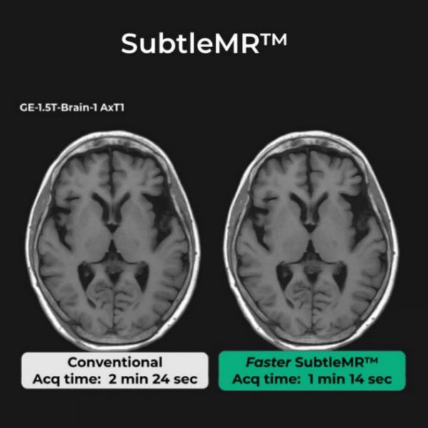 左为常规MRI扫描，右图中SubtleMR使得MRI扫描时间缩短，同时通过AI技术对图像质量进行增强